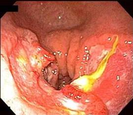 - Hyeong Seok Kim, et al. ALK negative ALCL - prognostic index (IPI) 4점의고위험군의환자에서 CHOP (cyclophosphamide, doxorubicin, vincristine, prednisolone) 항암화학요법으로완전관해를유지하고있는 1예를경험하였다.