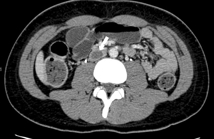 His abdominal pain subsided and elevated pancreatic enzymes returned to normal after mesalazine was discontinued. 부전산화단층촬영 (CT) 에서췌장은미만적인부종이보이고, 췌장주위지방침윤과액체저류 (fluid collection) 가관찰되었다 (Fig. 2).