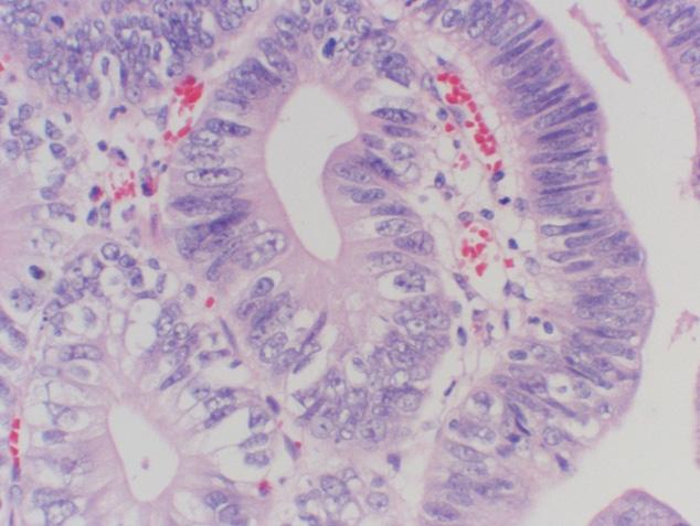 (A) It shows gastric adenocarcinoma arisen from