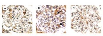 D Figure 4. Immunohistochemical staining for TGF-β1 in control (A), DM (B), and DM+LAB (C) glomeruli after 12 weeks.
