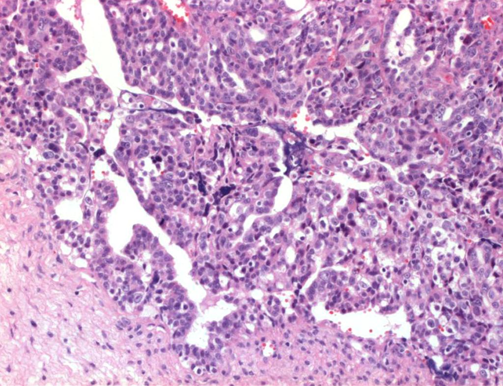 Two triangular small rudimentary uteruses are seen in the center. 보이고, 좌측골반내 4 cm 크기의종괴소견이보였다. 재발성난소암으로추정하여종양감축술을시행하였다. 우측대장부분절제술, 비장절제술, 부분대망절제술을시행하였고, 비장, 우측대장에전이된종괴및간표면과장간막, 대장에서다발성소결절들이확인되었다.