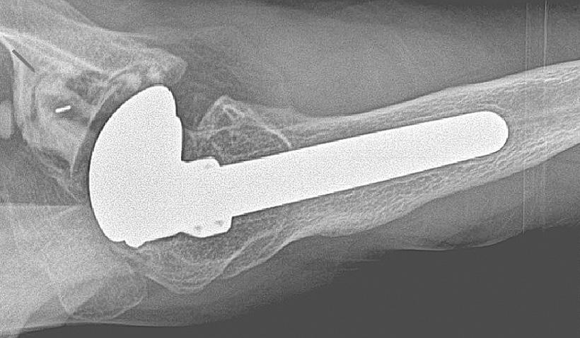 () Loosening and substantial subsidence of the humeral component (arrow) and loosening of the glenoid