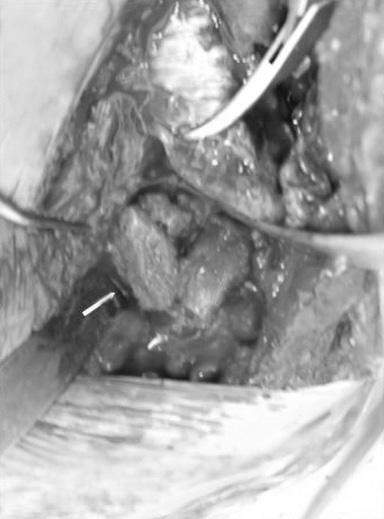 existed, glenoid cavity is filled with corticalcancellous bone grafts