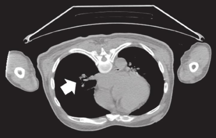 양전자단층촬영 (positron emission tomography, PET) (Fig. 1A) 에서우하엽, 종격동림프절 (5, 7, 10R), 그리고좌측치골의과대사부위가관찰되어악성림프절종대및골전이가확인되었다.