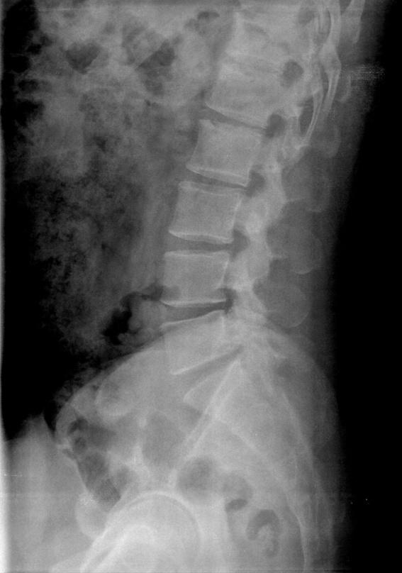 3), and squaring and sclerosis in the lower thoracic and lumbar spine.