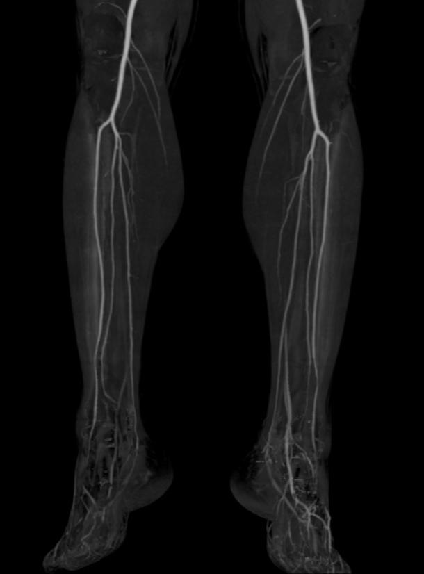 CT angiography of the lower extremities showed normal vasculature.