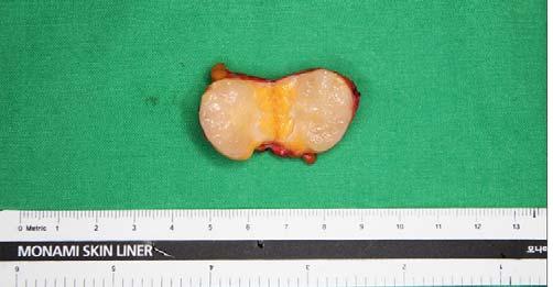 2 x 1.8 cm 크기의종괴가좌측경부상방에위치하였고, 광경근 (Platysma muscle) 하방으로낭종성덩어리가견장근육 (Strap muslce) 에부착되어있는형태로확인되었다 (Fig. 1). 초음파도시행하였다 (Fig. 2).