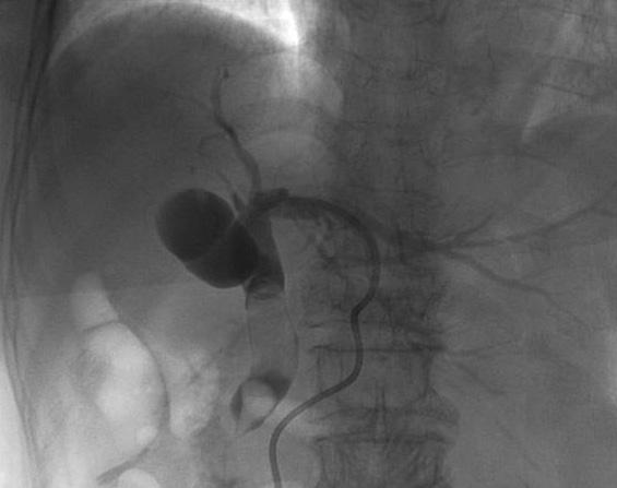 The ampullary sphincter was dilated using a 10 mm-sized balloon catheter. E.