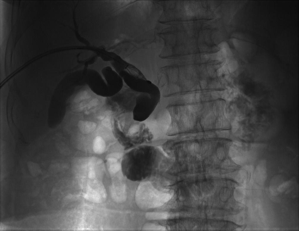 The ampullary sphincter was dilated using a 10 mm-sized balloon catheter (stone diameter: 13 mm, black arrow). D.