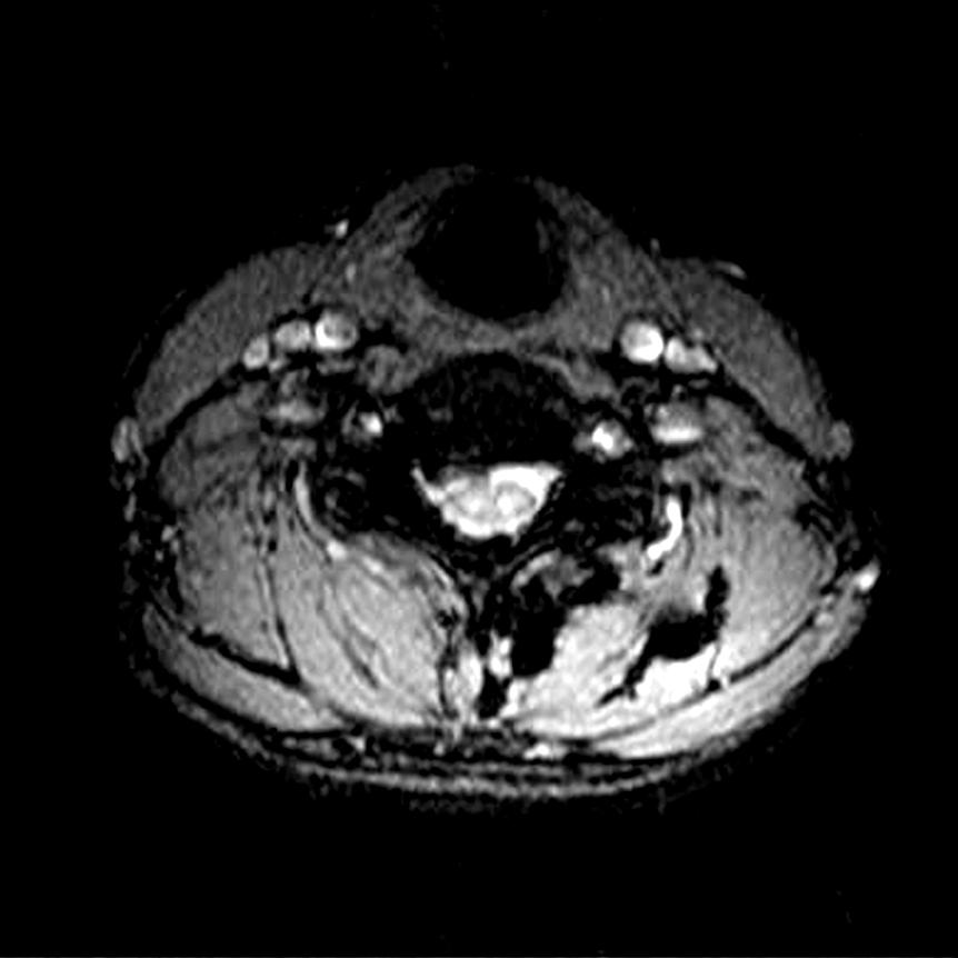 406 안영준ㆍ황창주ㆍ정경일 외 4인 ig. 1. T2 axial (A) and sagittal (B) MRI images showing compression of right 6th cervical nerve by a hard disc (Case 1).