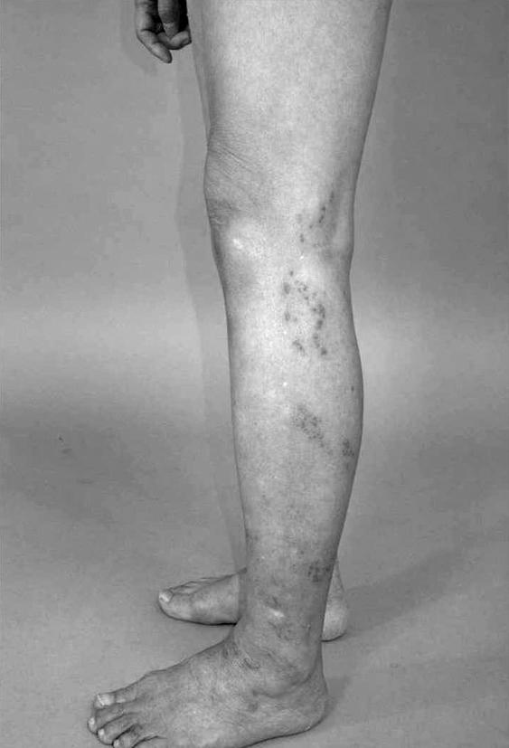 신경근증과혼동을일으키는대상포진 407 ig. 3. Clusters of erythematous papules in L5 and S1 dermatomes of left leg (Case 2). 는보이지않았다. 진통소염제를주사및경구로투약하여도전혀반응이없이통증이지속되어좌측제5 요추신경근에대한차단술을시행하였지만호전되지않았다.