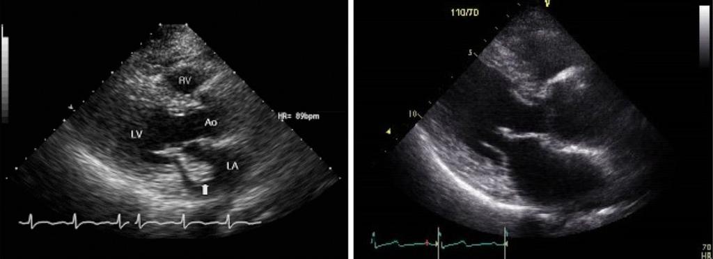 - Jin Kyung Kim, et al. Recovery from crescentic glomerulonephritis with bacterial endocarditis with antibiotics alone - A B Figure 1. Transthoracic echocardiogram.
