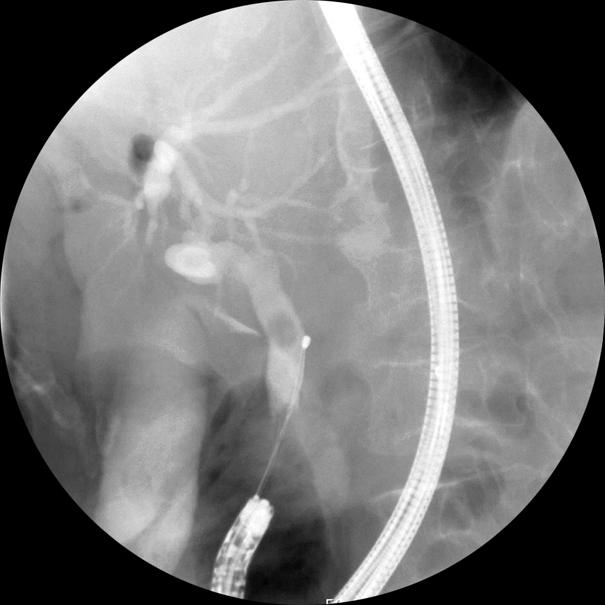 (A) Reversely positioned papilla is easily reached by forwardviewing endoscope.