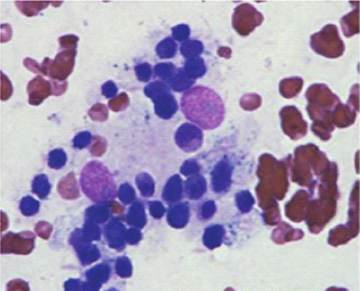 최계령 외: 클론성 염색체 이상을 보인 혈구포식 림프조직구증 1예 A B Fig. 1. Bone marrow aspirate and biopsy findings of the patient with hemophagocytic lymphohistiocytosis.