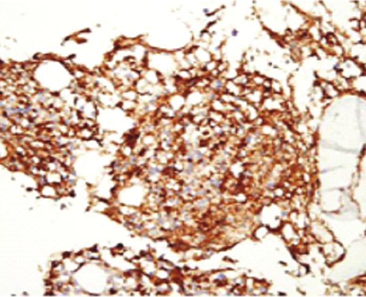 (B) Bone marrow biopsy section shows increased numbers of diffusely scattered CD68(+) macrophages (Immunohistocytochemical stain for CD68, 200).