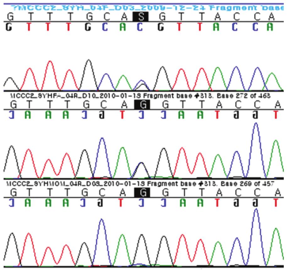 김병철 외: Novel Mutation of the MCCC2 Gene in 3-MCC Deficiency 3-HIVA-C, 혈장 아미노산 검사에서 류신, 요 유기산 분석 검사에 임신으로 제왕절개하였으며, 과거력상 특이소견이 없었다.