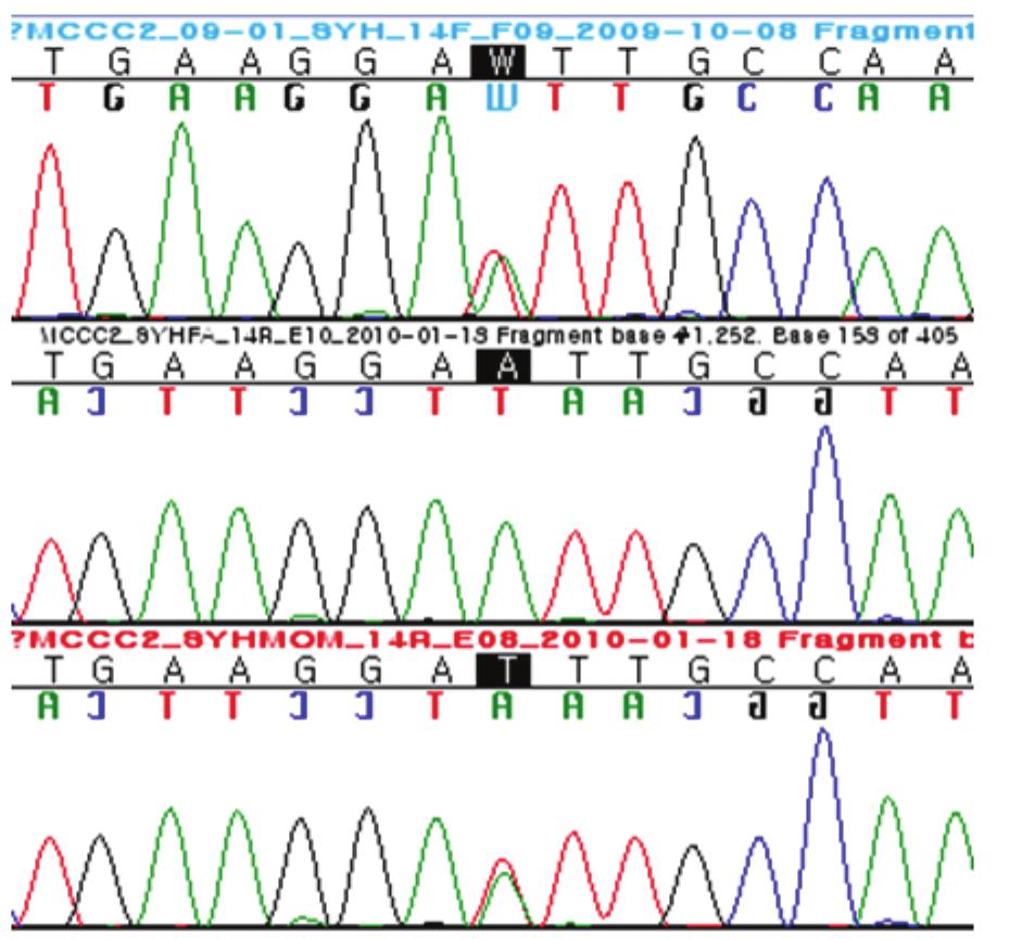 생후 80일째 유전자의 새로운 변이 2개가 관찰되어 3-MCC 결핍증으로 진단한 탠덤질량분석기를 이용한 신생아 선별검사에서 3-HIVA-C이 45.56 1예를 보고하고자 한다. μmol/l (참고치: < 0.65 μmol/l)로 증가된 소견을 보였고, 혈장 아 미노산 검사에서 류신이 258.0 μmol/l (참고치: 90.8 182.