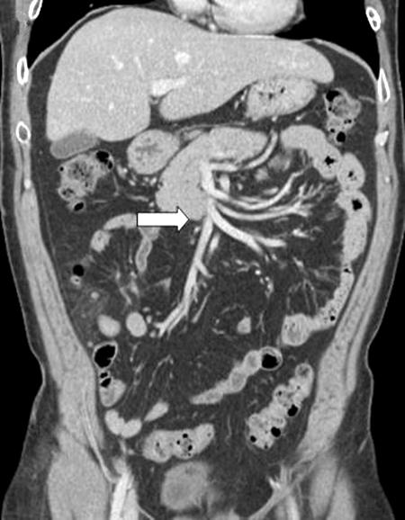 (A) Abdominal and pelvic CT scans, 28 days after discharge. The CT scans show no significant change in the right portal vein thrombi (white arrow).