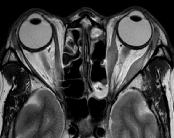 axial T1-weighted (c) images show diffuse enlargement and mild