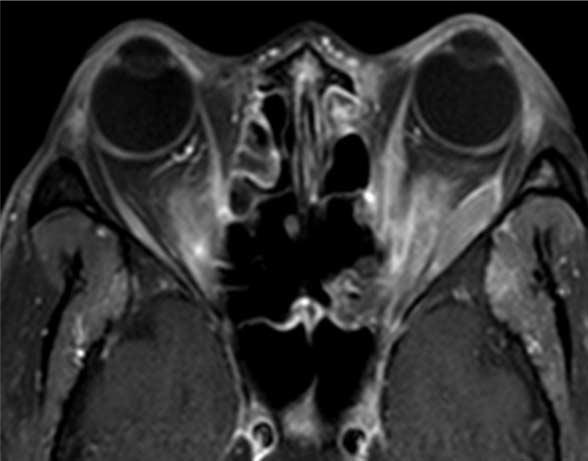 right lateral rectus muscles with sparing of the tendinous parts.