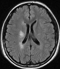 neuritis and brain involvement Attacks Symptoms MRI findings st (Oct, 1999) Right facial and left side