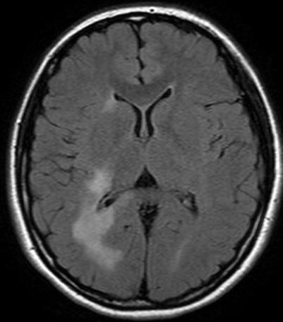 dizziness, nausea and vomiting Extended lesion in left pons, left frontal subcortical white matters 6 (Aug,