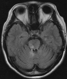 brainstem (Apr, 2007) Right leg weakness (Oct, 2007) Ataxic gait, dizziness and nystagmus Adjacent to e 4