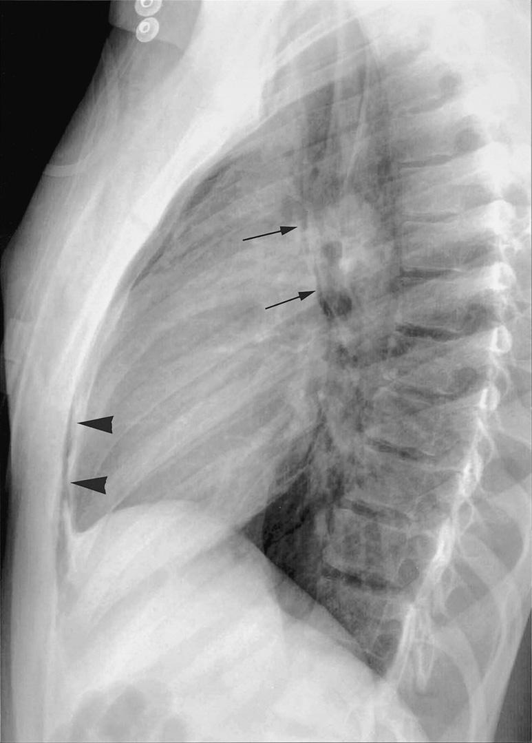 Frontal chest radiograph shows large pneumomediastinum elevating thymic lobes (arrows). Fig. 9.