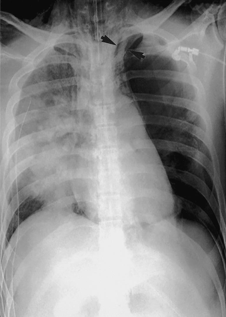 CT scan shows abnormal air collections surrounding the lung with communication to the pneumomediastinum.