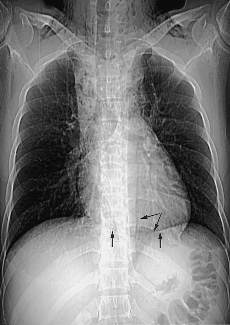 전경녀 외: 기흉, 기종격증, 심막기종 Fig. 13. Continuous diaphragm sign and Naclerio s V-sign in a 24-year-old man with pneumomediastinum from distal esophageal rupture.