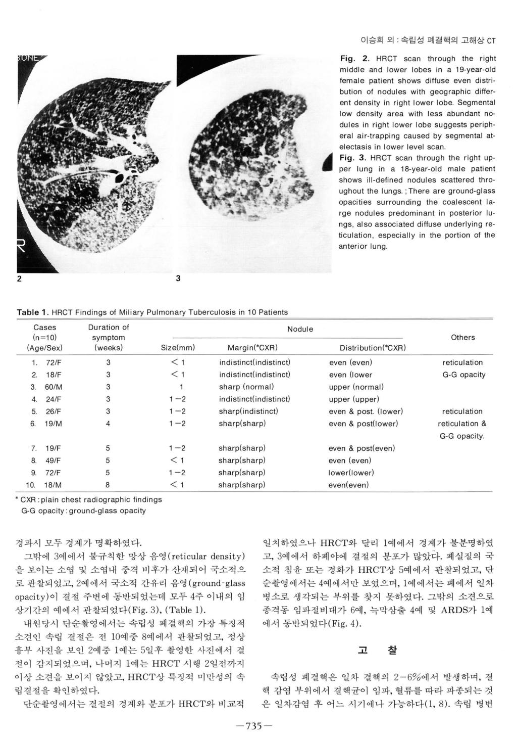 재이승희외 ; 속립성폐결핵의고해상 CT Fig. 2.