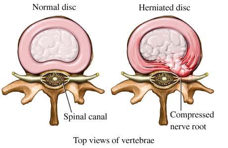 추간판헤르니아 (Hernia disc) 장시간동안추간판을압박하는자세로작업