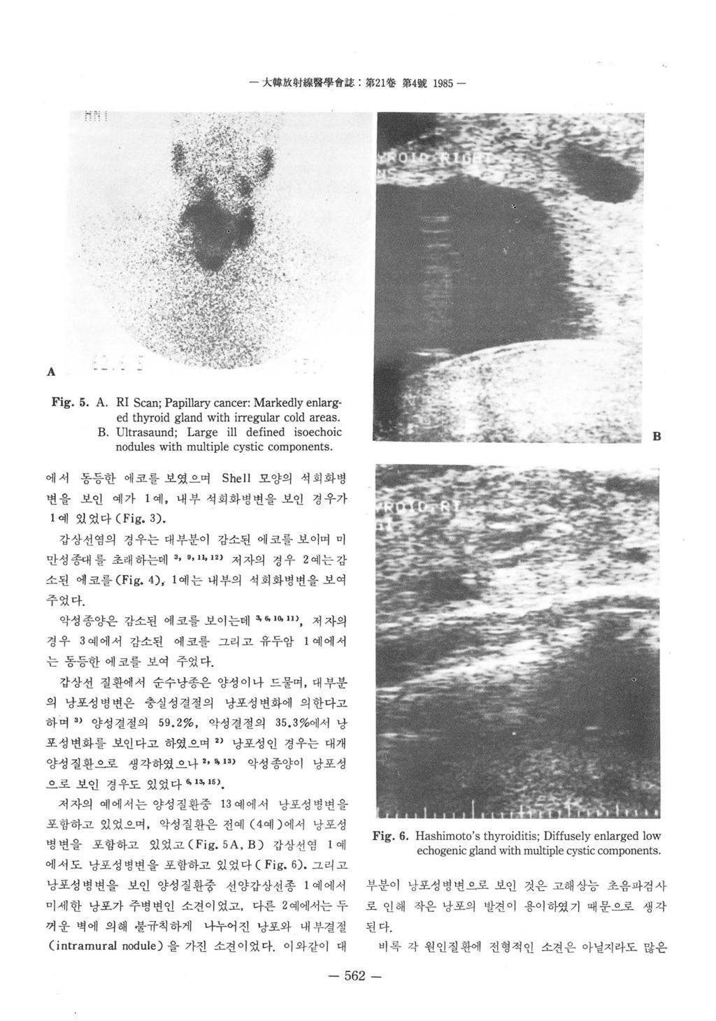 大韓放射線뽑學會홉 : 第 21 卷第 4 짧 1985 - - - A Fig. 5. A. RI Sc 때 ; Papillary cancer: Markedly enlarged thyroid gland with irregular cold areas. B.