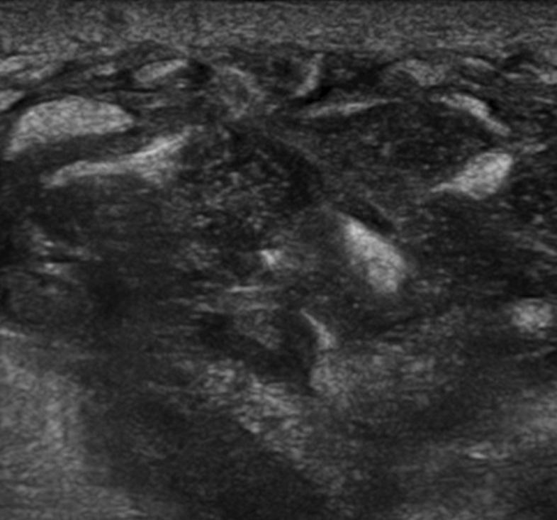 Jeonghui Lee, Pa Jong Jung: Ultrasonographic Finding of Breast and Thyroid Disorders Requiring Differential Diagnosis 성분과 함께 낭종내 혈류의 흐름(intramural blood flow 있다(Fig. 2A).