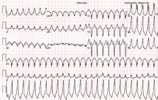 A ECG & EP Cases B Figure 1. Initial surface 12-lead ECG (A) and the ECG after administration of diltiazem (B).