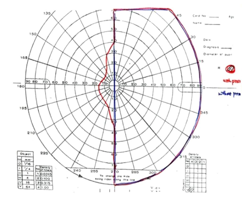 - 구현 문남주 : 동측반맹에서프레넬프리즘의이용 - A B Figure 1.