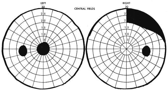 Kang B-H, et al. Visual Field Defects A B Fig. 5. Visual field defects produced by lesions at various points along the optic system.