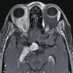 . 가장 대 C 측두반뱅(bitemporal hemianopia)이 나타나고, 시신경교차의 뒤쪽에 Fig. 6.