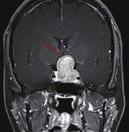 Axon labeling 방법을 이용한 정상 원숭이를 대상으 병변을 먼저 고려해 볼 수 있고, 상대동공부등장애(RAPD)를 동반한 로 한 연구에서는 이를 실제로 확인할 수가 없었고, 이후 눈을 제거한 다면 가쪽무릎체 병변과 감별할 수 있다. 시각로에 포함되어 있는 동 원숭이에서 이러한 구조를 확인할 수 있었다고 한다.