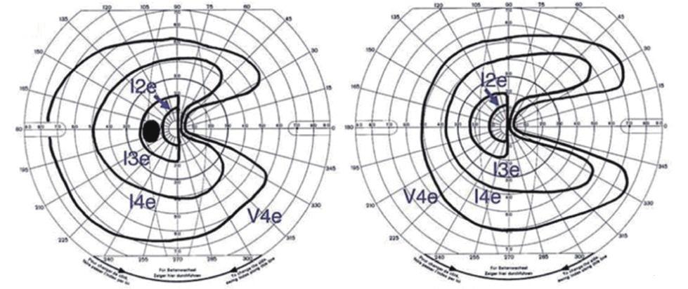 시야장애 강봉희외 Anterior choroidal artery Lateral horn Macular zone: posterior choroidal artery Hi lum 위축소견이양안에서보일수있다 (hemianopic optic atrophy). 4 가쪽무릎체병변에의한시야결손 Anterior choroidal artery Medial horn Fig.