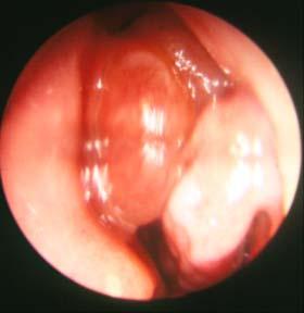 polyp and normal
