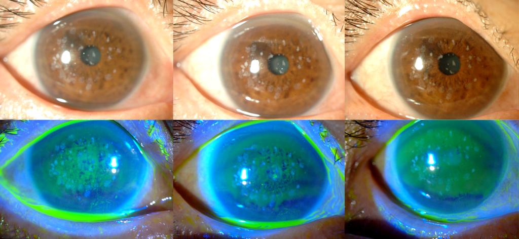 - 류영주외 : 과립형각막이상증에서굴절교정각막절제술 - A B C D E F Figure 1. Anterior segment photos of delayed wound healing after photorefractive keratectomy (PRK) in a granular corneal dystrophy patient.