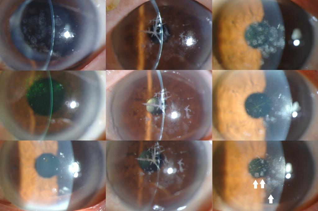After applying bandage contact lens, the punctate epithelial erosion much decreased but irregular corneal surface remained (B, E) 1 month after PRK. Using topical fluorometholone 0.