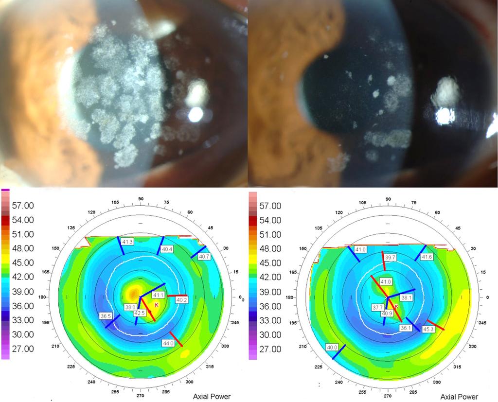 - 대한안과학회지 2015 년제 56 권제 8 호 - A B C D Figure 3. Representative (A) pre- and (B) post-operative photorefractive keratectomy photographs of the eye which showed central island postoperatively.