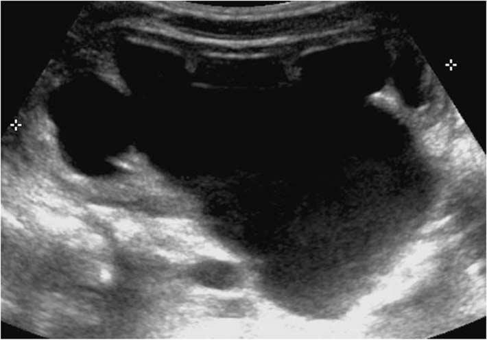 대한초음파의학회지 2013;32(2) 폐쇄성요관확장이생길수있다. 또한 renal hilum 부위에돌출된혈관에의해서도수신증과같은소견이나타날수있다. 신장내혈관에대한도플러검사도폐쇄성과비폐쇄성수신증을감별하는데도움이될수있다.