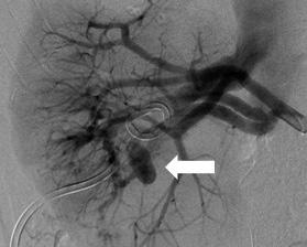 Successful percutaneous nephrostomy was performed in the mid to low pole.