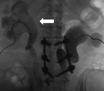 A 69-year-old woman with cervical cancer given bilateral D-J stents for double-sided ureteral invasion. A.