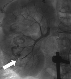 B. After removal of both D-J stents with snares, percutaneous nephrostomy was performed successfully.