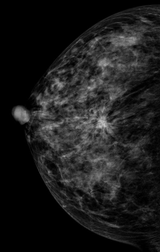 영상의학과전공의들의선별유방촬영판독성취도 A B Fig. 2. A 56-year-old woman with screening-detected invasive ductal carcinoma in her right breast.