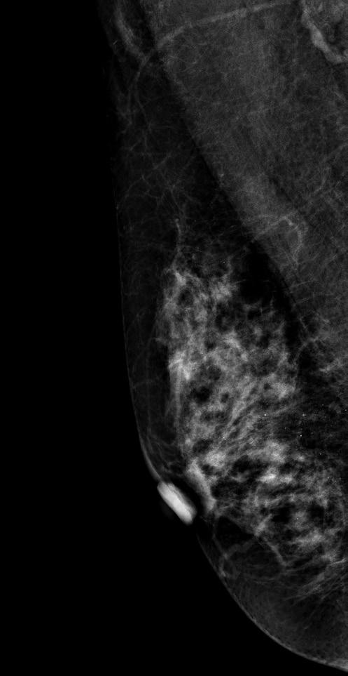 It was the most common true-positive case. However, not all residents interpreted this mass correctly: 95.9% of trainees and 93.9% of non-trainees were correct.